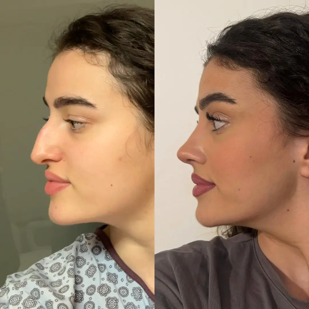 RHINOPLASTY